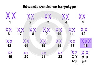 Edwards syndrome karyotype photo