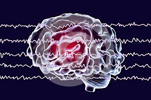 EEG Electroencephalogram, brain wave in awake state with mental activity