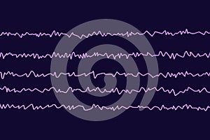 EEG Electroencephalogram, brain wave in awake state with mental activity