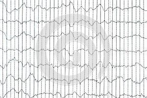 EEG electrophysiological monitoring method. EEG wave in human br photo