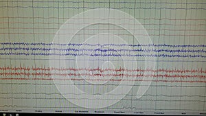 EEG Showing Brainwave Tracings from Multiple Leads
