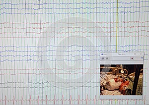 EEG Showing Diffuse Slowing on Multiple Leads