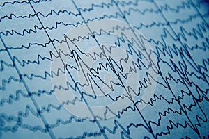 EEG wave in human brain, brain wave patterns on electroencephalogram, problems in the electrical activity of the brain