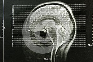 EEG x-ray skulls photo