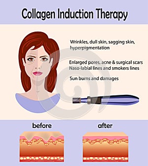 Before after effect, Microneedle stamping device, Collagen induction therapy