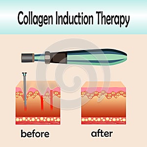 Before after effect, Microneedle stamping device, Collagen induction therapy photo