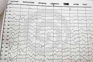 EG electro physiological monitoring method. EEG wave in human brain, EEG of the child, problems in the electrical activity of the