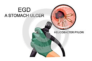 EGD, diagnosis of gastric ulcer