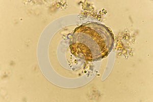 Egg of Ascaris lumbricoides in stool