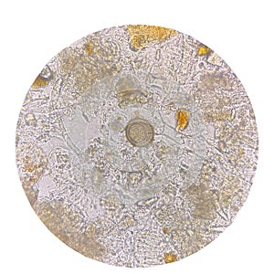 Egg of parasite in stool exam