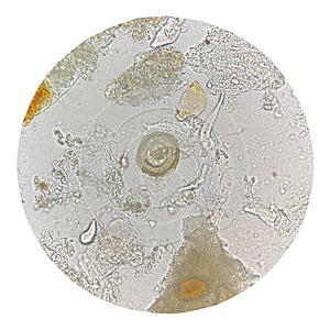 Egg of parasite in stool exam
