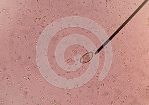 Egg of parasite in stool exam.