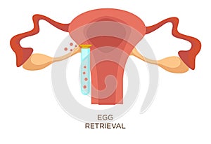 Egg retrieval stage in vitro fertilization artificial insemination
