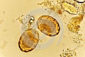 Eggs of Ascaris lumbricoides in stool