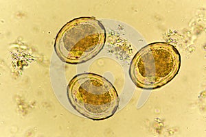 Eggs of Ascaris lumbricoides in stool