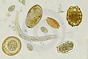 Eggs of helminthes in stool