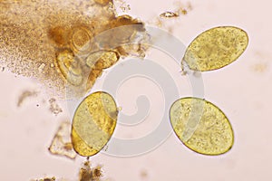 Eggs of intestinal fluke in human stool