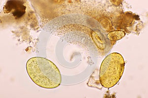 Eggs of intestinal fluke in human stool