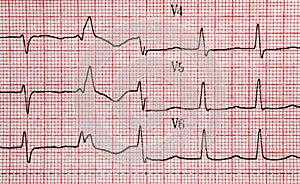 EKG