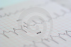 EKG