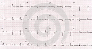 EKG photo