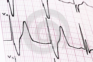 Ekg