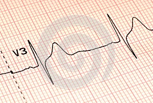 EKG