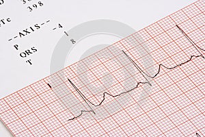 EKG chart