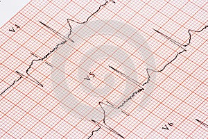 EKG chart