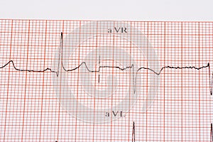 EKG chart