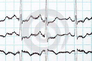 EKG diagram