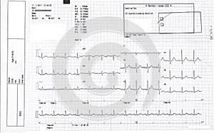 EKG, ecg graph, Electrocardiogram ecg on paper
