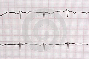 Ekg/ ecg - medical background