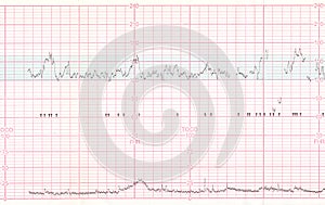 EKG or ECG result