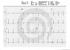 EKG or ECG result from a Treadmill Stress Test