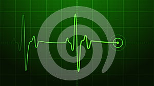 EKG - Electrocardiogram