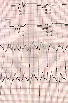 EKG Electrocardiology Graph