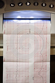 EKG graph