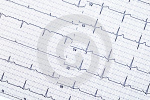 Ekg graph paper on a white background