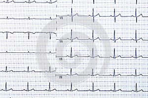 Ekg graph paper on a white background