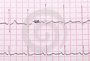 EKG printout photo