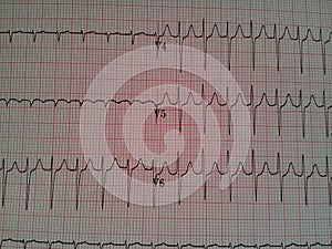 EKG with Rhythm Strip showing Tachycardia on Chest Leads