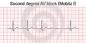 EKG second degree AV block Mobitz I
