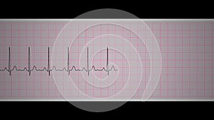 Ekg sinus tachycardia