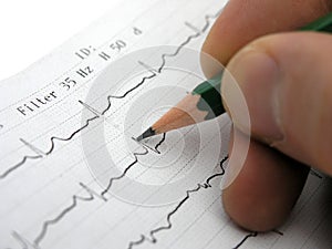 EKG test results