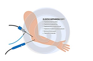 Elbow arthroscopy surgery