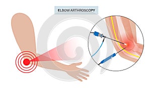 Elbow arthroscopy surgery
