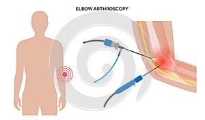 Elbow arthroscopy surgery