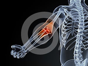 Elbow bursitis