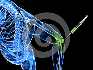 Elbow joint injection